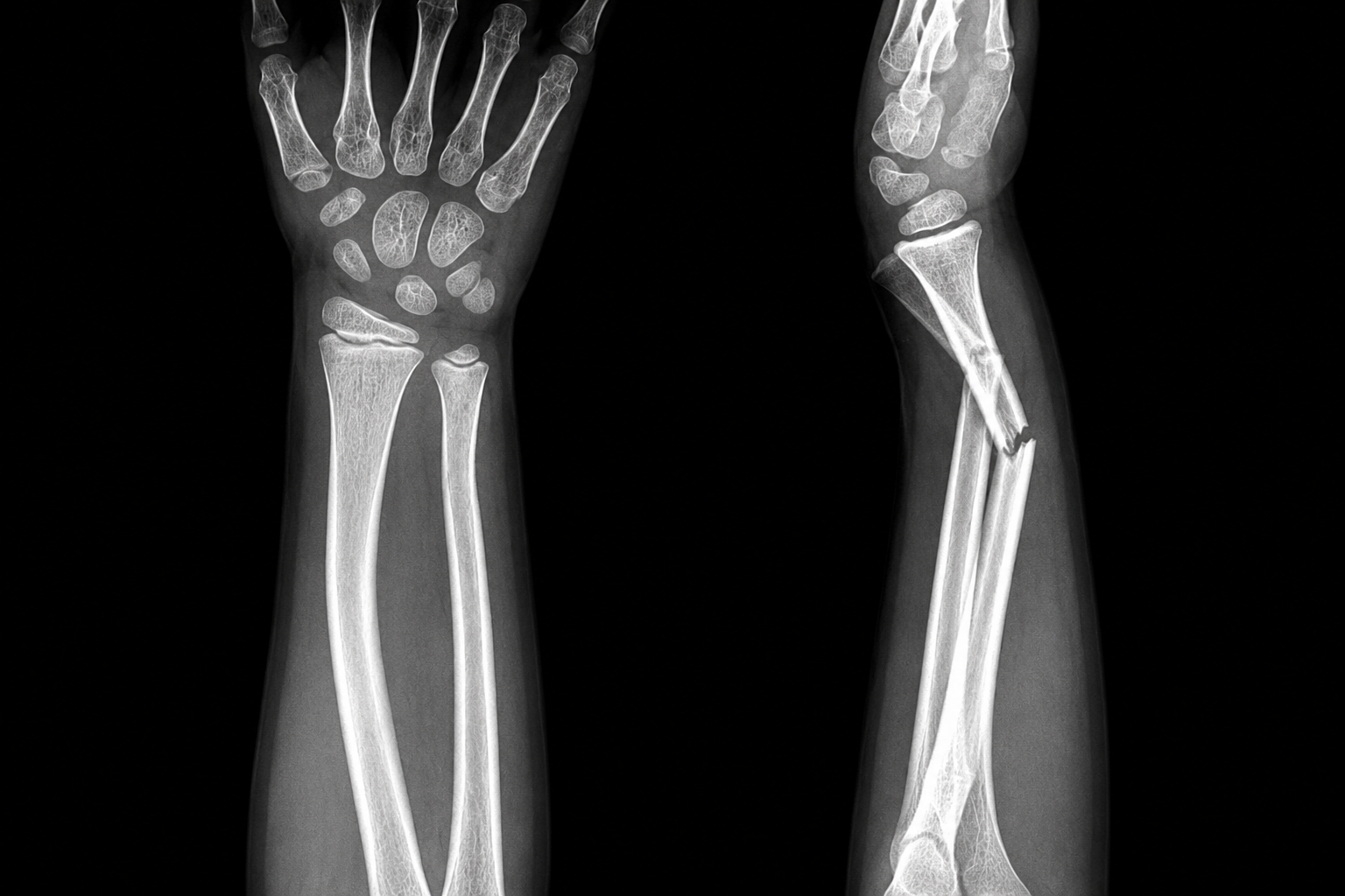 Complex Trauma Surgery and Fracture Treatment at Dr. Vinoth's Advanced Ortho Clinic